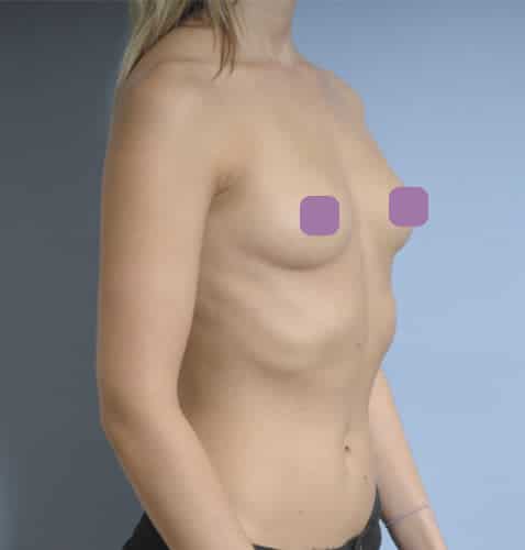 Breast Asymmetry Surgery in Perth